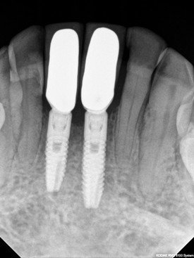 Implant-Crowns gallery